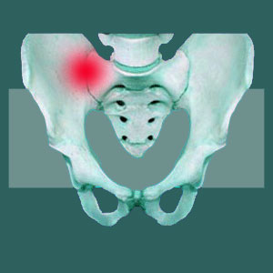 Mechanical Sacroiliac Pain